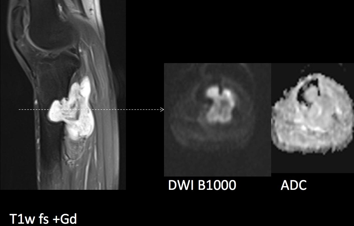 Figure 4 for case Dedifferentiated liposarcoma ( RID4360 )
